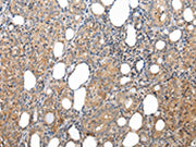 The image on the left is immunohistochemistry of paraffin-embedded Human thyroid cancer tissue using CSB-PA231733(XKRX Antibody) at dilution 1/25, on the right is treated with synthetic peptide. (Original magnification: ×200)