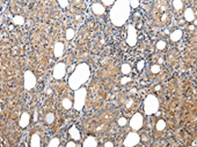 The image on the left is immunohistochemistry of paraffin-embedded Human thyroid cancer tissue using CSB-PA231733(XKRX Antibody) at dilution 1/25, on the right is treated with synthetic peptide. (Original magnification: ×200)