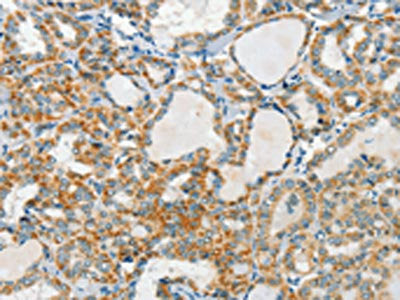 The image on the left is immunohistochemistry of paraffin-embedded Human thyroid cancer tissue using CSB-PA231814(AANAT Antibody) at dilution 1/40, on the right is treated with fusion protein. (Original magnification: ×200)