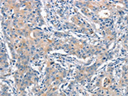 The image on the left is immunohistochemistry of paraffin-embedded Human gastic cancer tissue using CSB-PA231989(ANAPC1 Antibody) at dilution 1/15, on the right is treated with synthetic peptide. (Original magnification: ×200)