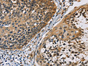 The image on the left is immunohistochemistry of paraffin-embedded Human cervical cancer tissue using CSB-PA232262(CBR1 Antibody) at dilution 1/40, on the right is treated with fusion protein. (Original magnification: ×200)