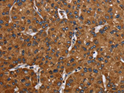 The image on the left is immunohistochemistry of paraffin-embedded Human liver cancer tissue using CSB-PA232292(C12orf75 Antibody) at dilution 1/20, on the right is treated with synthetic peptide. (Original magnification: ×200)