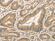 The image on the left is immunohistochemistry of paraffin-embedded Human colon cancer tissue using CSB-PA232587(CDCA8 Antibody) at dilution 1/40, on the right is treated with fusion protein. (Original magnification: ×200)