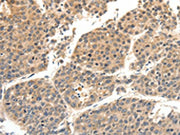 The image on the left is immunohistochemistry of paraffin-embedded Human liver cancer tissue using CSB-PA232605(SLC27A1 Antibody) at dilution 1/40, on the right is treated with synthetic peptide. (Original magnification: ×200)