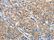 The image on the left is immunohistochemistry of paraffin-embedded Human lung cancer tissue using CSB-PA232631(ARFGAP1 Antibody) at dilution 1/30, on the right is treated with fusion protein. (Original magnification: ×200)