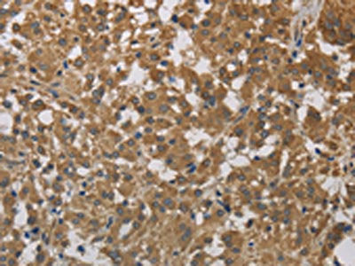 The image on the left is immunohistochemistry of paraffin-embedded Human thyroid cancer tissue using CSB-PA232766(CYB5A Antibody) at dilution 1/40, on the right is treated with fusion protein. (Original magnification: ×200)