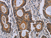 The image on the left is immunohistochemistry of paraffin-embedded Human colon cancer tissue using CSB-PA232889(PARP8 Antibody) at dilution 1/40, on the right is treated with synthetic peptide. (Original magnification: ×200)