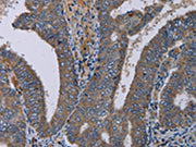 The image on the left is immunohistochemistry of paraffin-embedded Human colon cancer tissue using CSB-PA232987(PVRL4 Antibody) at dilution 1/40, on the right is treated with fusion protein. (Original magnification: ×200)