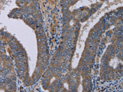 The image on the left is immunohistochemistry of paraffin-embedded Human colon cancer tissue using CSB-PA232987(PVRL4 Antibody) at dilution 1/40, on the right is treated with fusion protein. (Original magnification: ×200)