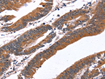 The image on the left is immunohistochemistry of paraffin-embedded Human colon cancer tissue using CSB-PA233008(GREB1 Antibody) at dilution 1/40, on the right is treated with synthetic peptide. (Original magnification: ×200)