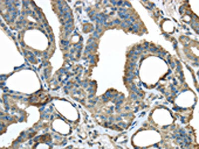 The image on the left is immunohistochemistry of paraffin-embedded Human thyroid cancer tissue using CSB-PA233073(ERP44 Antibody) at dilution 1/30, on the right is treated with fusion protein. (Original magnification: ×200)