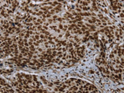 The image on the left is immunohistochemistry of paraffin-embedded Human cervical cancer tissue using CSB-PA233075(LEO1 Antibody) at dilution 1/20, on the right is treated with synthetic peptide. (Original magnification: ×200)
