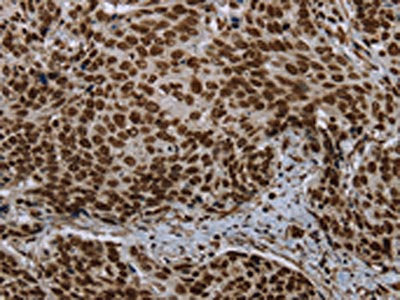 The image on the left is immunohistochemistry of paraffin-embedded Human cervical cancer tissue using CSB-PA233075(LEO1 Antibody) at dilution 1/20, on the right is treated with synthetic peptide. (Original magnification: ×200)