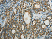 The image on the left is immunohistochemistry of paraffin-embedded Human thyroid cancer tissue using CSB-PA233120(CTSV Antibody) at dilution 1/50, on the right is treated with fusion protein. (Original magnification: ×200)