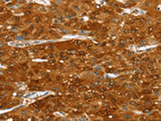 The image on the left is immunohistochemistry of paraffin-embedded Human liver cancer tissue using CSB-PA233200(SULT2A1 Antibody) at dilution 1/20, on the right is treated with fusion protein. (Original magnification: ×200)