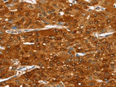 The image on the left is immunohistochemistry of paraffin-embedded Human liver cancer tissue using CSB-PA233200(SULT2A1 Antibody) at dilution 1/20, on the right is treated with fusion protein. (Original magnification: ×200)
