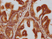 IHC image of CSB-PA23329A0Rb diluted at 1:300 and staining in paraffin-embedded human prostate cancer performed on a Leica BondTM system. After dewaxing and hydration, antigen retrieval was mediated by high pressure in a citrate buffer (pH 6.0). S...