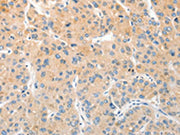 The image on the left is immunohistochemistry of paraffin-embedded Human liver cancer tissue using CSB-PA233350(RPN1 Antibody) at dilution 1/30, on the right is treated with fusion protein. (Original magnification: ×200)