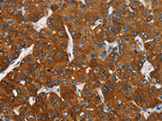 The image on the left is immunohistochemistry of paraffin-embedded Human liver cancer tissue using CSB-PA233585(CARD9 Antibody) at dilution 1/70, on the right is treated with fusion protein. (Original magnification: ×200)