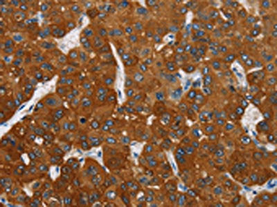 The image on the left is immunohistochemistry of paraffin-embedded Human liver cancer tissue using CSB-PA233585(CARD9 Antibody) at dilution 1/70, on the right is treated with fusion protein. (Original magnification: ×200)