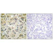 Immunohistochemistry analysis of paraffin-embedded human colon carcinoma tissue using Vimentin antibody.