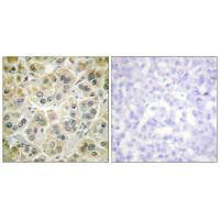 Immunohistochemistry analysis of paraffin-embedded human colon carcinoma tissue using Vimentin antibody.