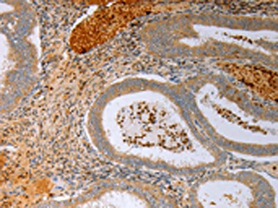 The image on the left is immunohistochemistry of paraffin-embedded Human cervical cancer tissue using CSB-PA233653(FOXN1 Antibody) at dilution 1/15, on the right is treated with synthetic peptide. (Original magnification: ×200)