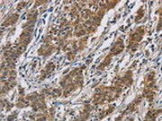 The image is immunohistochemistry of paraffin-embedded Human gastic cancer tissue using CSB-PA233715(SIGMAR1 Antibody) at dilution 1/50. (Original magnification: ×200)