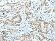 The image on the left is immunohistochemistry of paraffin-embedded Human colon cancer tissue using CSB-PA233816(ASH2L Antibody) at dilution 1/60, on the right is treated with fusion protein. (Original magnification: ×200)