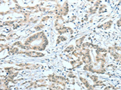 The image on the left is immunohistochemistry of paraffin-embedded Human colon cancer tissue using CSB-PA233816(ASH2L Antibody) at dilution 1/60, on the right is treated with fusion protein. (Original magnification: ×200)