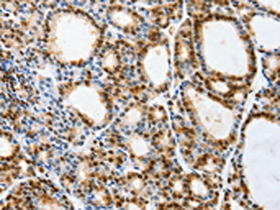 The image on the left is immunohistochemistry of paraffin-embedded Human thyroid cancer tissue using CSB-PA233851(VIMP Antibody) at dilution 1/40, on the right is treated with synthetic peptide. (Original magnification: ×200)