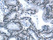 The image on the left is immunohistochemistry of paraffin-embedded Human colon cancer tissue using CSB-PA234128(RPL15 Antibody) at dilution 1/25, on the right is treated with fusion protein. (Original magnification: ×200)