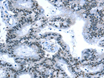 The image on the left is immunohistochemistry of paraffin-embedded Human colon cancer tissue using CSB-PA234128(RPL15 Antibody) at dilution 1/25, on the right is treated with fusion protein. (Original magnification: ×200)