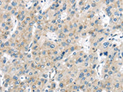 The image on the left is immunohistochemistry of paraffin-embedded Human liver cancer tissue using CSB-PA234289(VPS26A Antibody) at dilution 1/40, on the right is treated with synthetic peptide. (Original magnification: ×200)