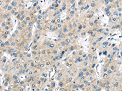 The image on the left is immunohistochemistry of paraffin-embedded Human liver cancer tissue using CSB-PA234289(VPS26A Antibody) at dilution 1/40, on the right is treated with synthetic peptide. (Original magnification: ×200)
