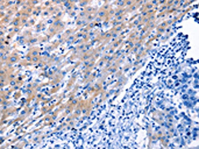 The image on the left is immunohistochemistry of paraffin-embedded Human liver cancer tissue using CSB-PA234333(LAMA3 Antibody) at dilution 1/30, on the right is treated with synthetic peptide. (Original magnification: ×200)