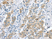 The image on the left is immunohistochemistry of paraffin-embedded Human liver cancer tissue using CSB-PA234397(LRP6 Antibody) at dilution 1/60, on the right is treated with synthetic peptide. (Original magnification: ×200)
