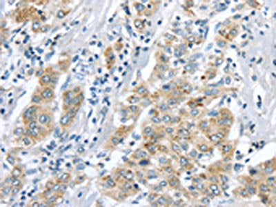 The image on the left is immunohistochemistry of paraffin-embedded Human liver cancer tissue using CSB-PA234397(LRP6 Antibody) at dilution 1/60, on the right is treated with synthetic peptide. (Original magnification: ×200)