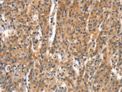 The image on the left is immunohistochemistry of paraffin-embedded Human gastic cancer tissue using CSB-PA234417(DEAF1 Antibody) at dilution 1/15, on the right is treated with synthetic peptide. (Original magnification: ×200)