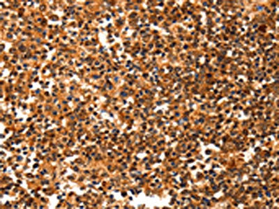 The image on the left is immunohistochemistry of paraffin-embedded Human tonsil tissue using CSB-PA234560(YWHAQ Antibody) at dilution 1/20, on the right is treated with synthetic peptide. (Original magnification: ×200)