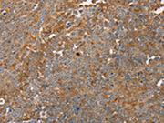 The image on the left is immunohistochemistry of paraffin-embedded Human ovarian cancer tissue using CSB-PA234848(FAIM2 Antibody) at dilution 1/30, on the right is treated with fusion protein. (Original magnification: ×200)
