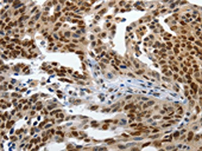 The image on the left is immunohistochemistry of paraffin-embedded Human ovarian cancer tissue using CSB-PA234904(KLF5 Antibody) at dilution 1/120, on the right is treated with synthetic peptide. (Original magnification: ×200)