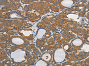 The image on the left is immunohistochemistry of paraffin-embedded Human thyroid cancer tissue using CSB-PA234947(PPP2CB Antibody) at dilution 1/80, on the right is treated with synthetic peptide. (Original magnification: ×200)