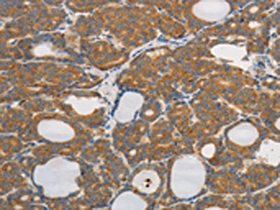 The image on the left is immunohistochemistry of paraffin-embedded Human thyroid cancer tissue using CSB-PA234947(PPP2CB Antibody) at dilution 1/80, on the right is treated with synthetic peptide. (Original magnification: ×200)