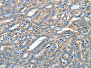The image on the left is immunohistochemistry of paraffin-embedded Human thyroid cancer tissue using CSB-PA235182(ANGPT1 Antibody) at dilution 1/50, on the right is treated with fusion protein. (Original magnification: ×200)