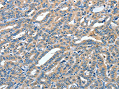 The image on the left is immunohistochemistry of paraffin-embedded Human thyroid cancer tissue using CSB-PA235182(ANGPT1 Antibody) at dilution 1/50, on the right is treated with fusion protein. (Original magnification: ×200)
