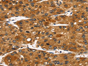 The image on the left is immunohistochemistry of paraffin-embedded Human liver cancer tissue using CSB-PA235316(TACC2 Antibody) at dilution 1/40, on the right is treated with synthetic peptide. (Original magnification: ×200)