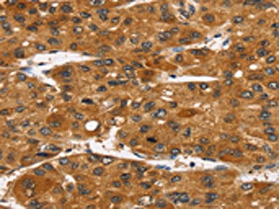 The image on the left is immunohistochemistry of paraffin-embedded Human liver cancer tissue using CSB-PA235316(TACC2 Antibody) at dilution 1/40, on the right is treated with synthetic peptide. (Original magnification: ×200)