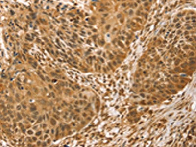 The image on the left is immunohistochemistry of paraffin-embedded Human esophagus cancer tissue using CSB-PA235335(VMP1 Antibody) at dilution 1/30, on the right is treated with synthetic peptide. (Original magnification: ×200)