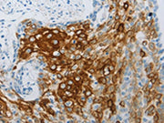 The image on the left is immunohistochemistry of paraffin-embedded Human cervical cancer tissue using CSB-PA235658(FLG Antibody) at dilution 1/30, on the right is treated with synthetic peptide. (Original magnification: X200)